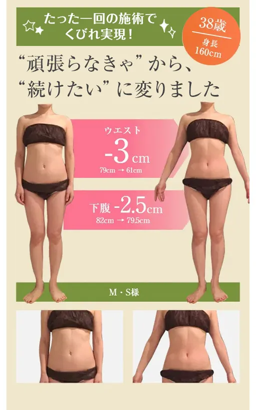 たった1回の施術でくびれ実現
ウエスト-3cm（79cm→61cm）
下腹-2.5cm（82cm→79.5cm）
