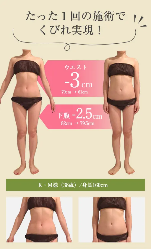 たった1回の施術でくびれ実現
ウエスト-3cm（79cm→61cm）
下腹-2.5cm（82cm→79.5cm）
